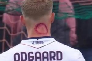 被僵尸咬了?奥德加德脖子现恐怖红斑,赛后回应是脖子用的药